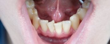 invisalign before and after worst cases
