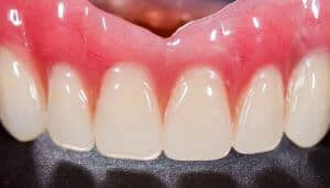 mini implant retained dentures cost