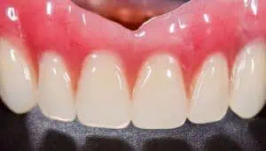 implant retained dentures price uk