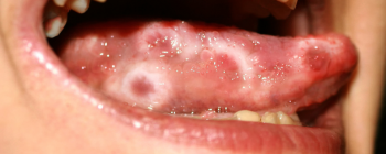 herpes on tongue