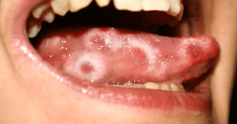 herpes on tongue
