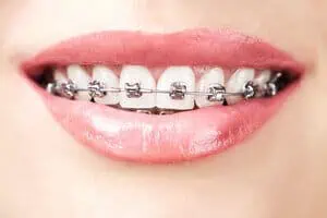 orthodontic treatment 