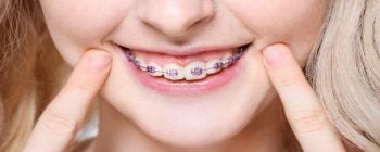 How and Why DIY Braces are Dangerous