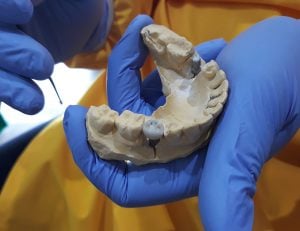 dental implants experiences