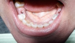 holes from teeth implants