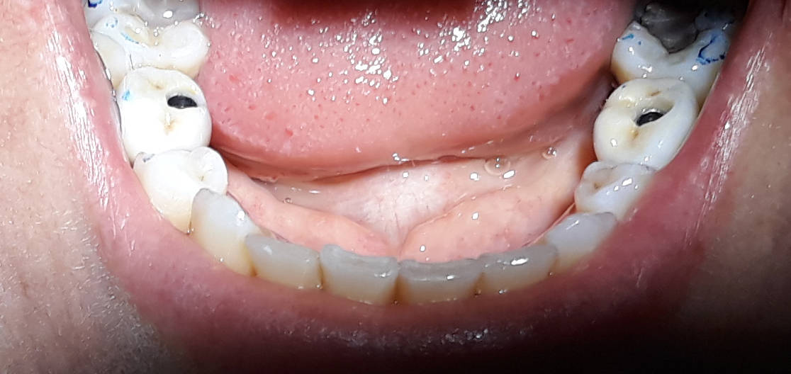 Dental Implants Experience Healing and Pain After Implants