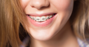 radiance clear braces cost