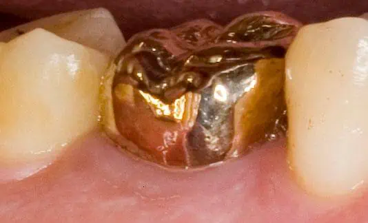 gold crown tooth cost uk