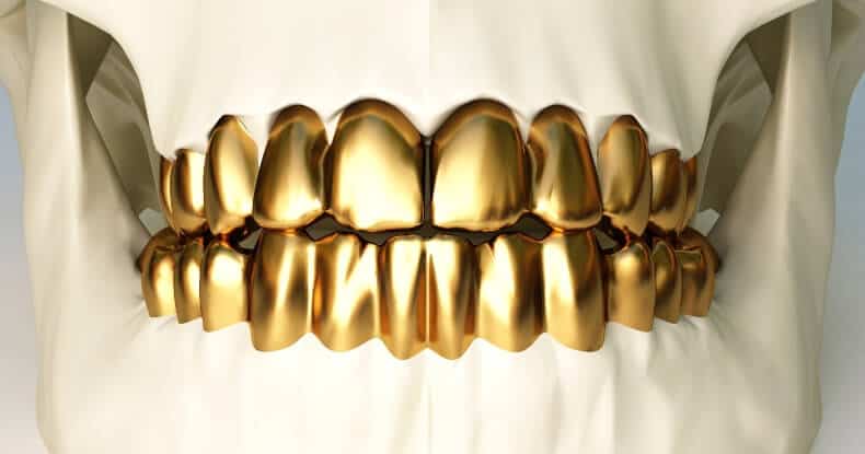 permanent gold teeth implants