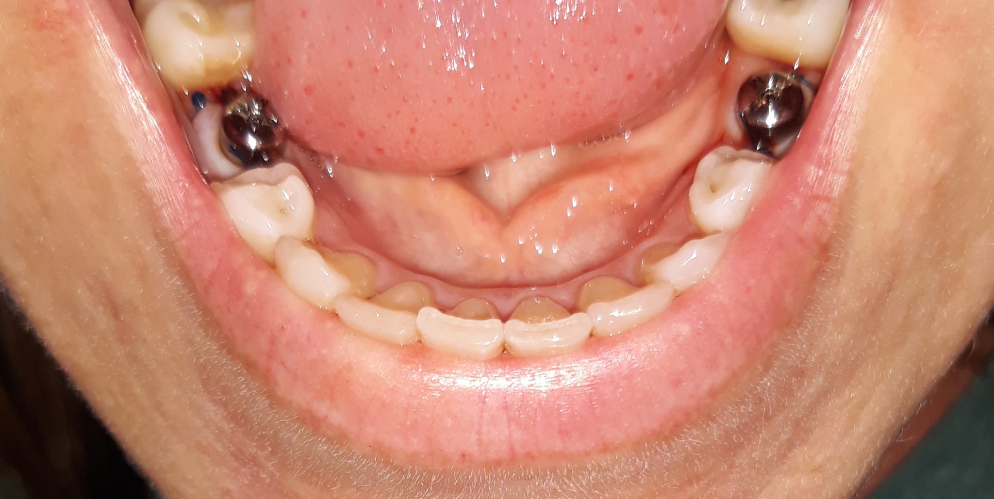Dental Implants Experience Healing and Pain After Implants
