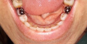 swelling after dental implant experience