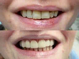 composite veneers before and after