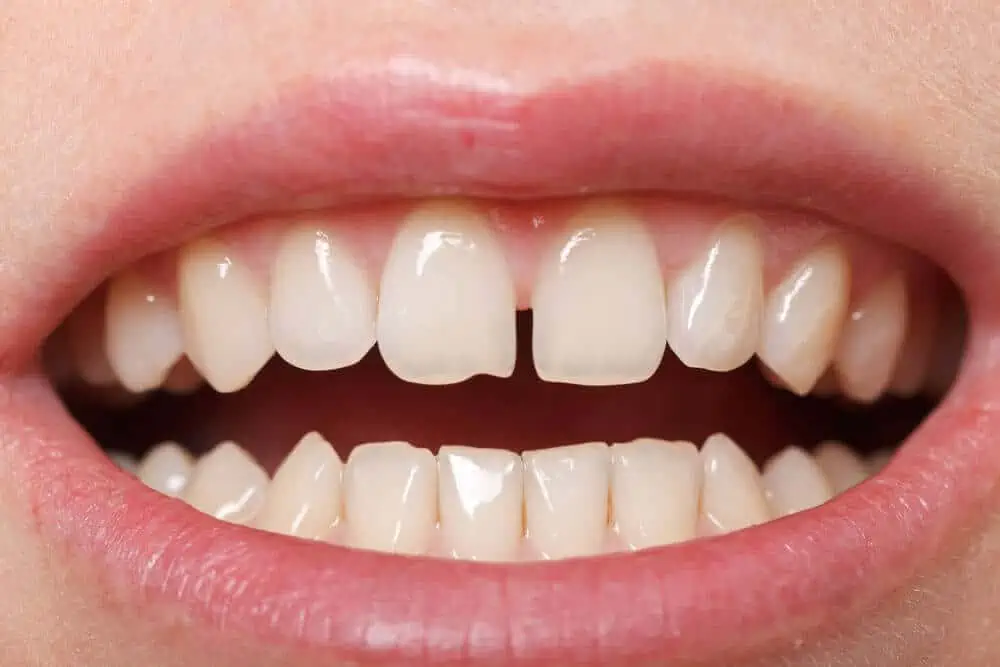 edge bonding teeth