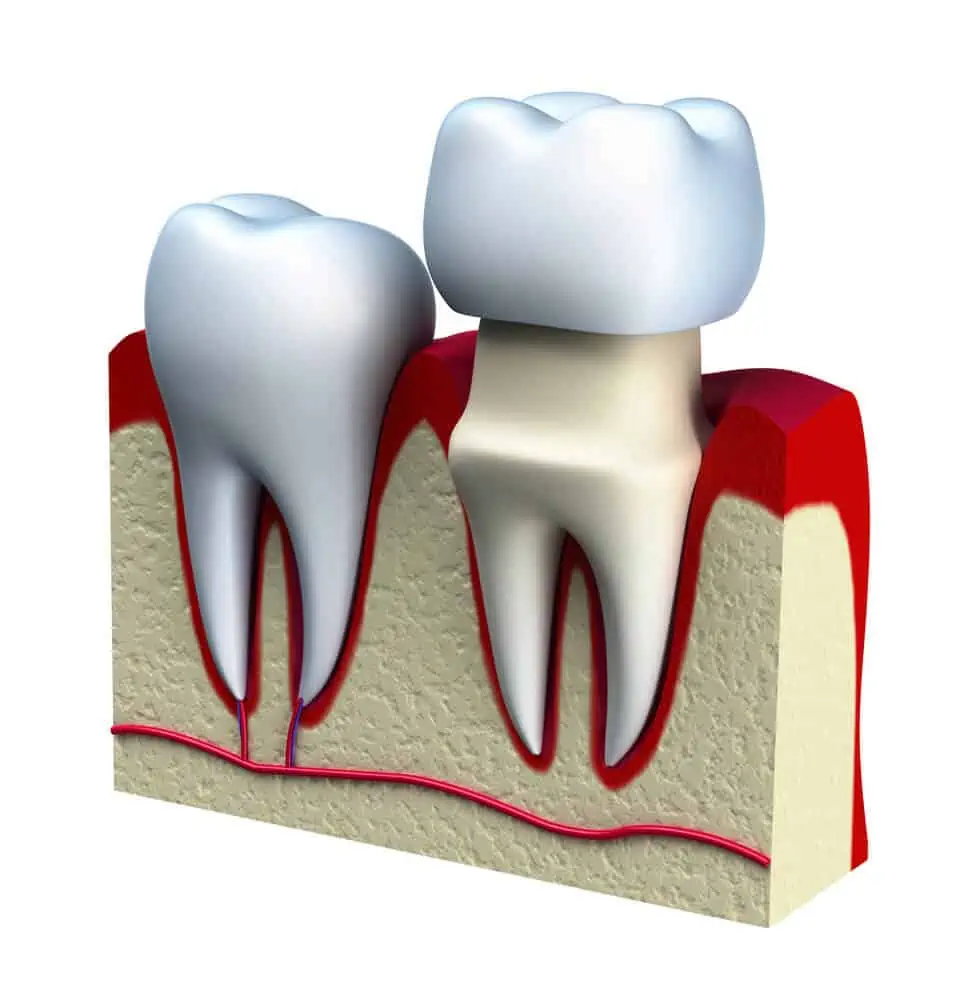 emax dental crowns front teeth