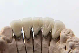 cementing emax crowns