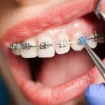 40348Crossbite Teeth: Treating an Uneven Jaw with Surgery or Braces