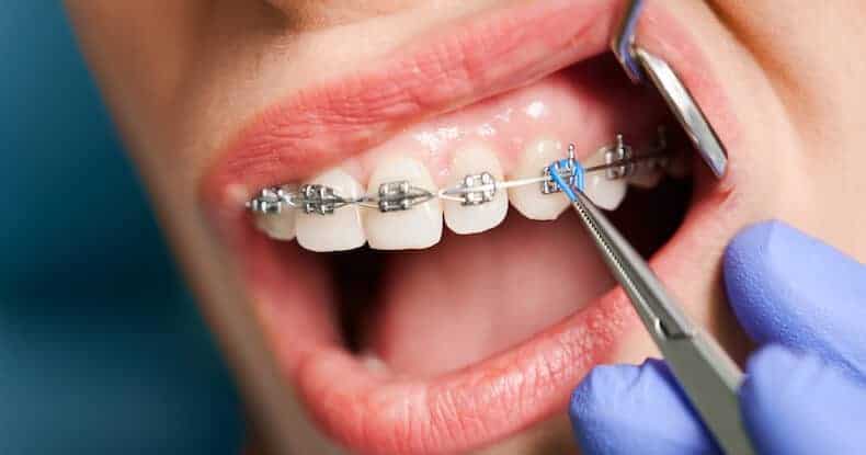 how are braces tightened