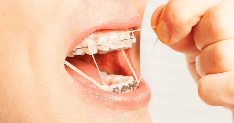 elastic-bands-for-braces