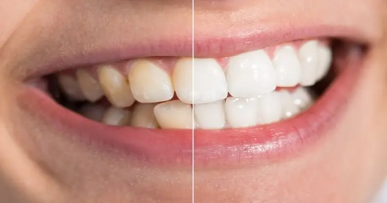 35209Open Bite Problems and Treatment with Surgery, Braces or Veneers