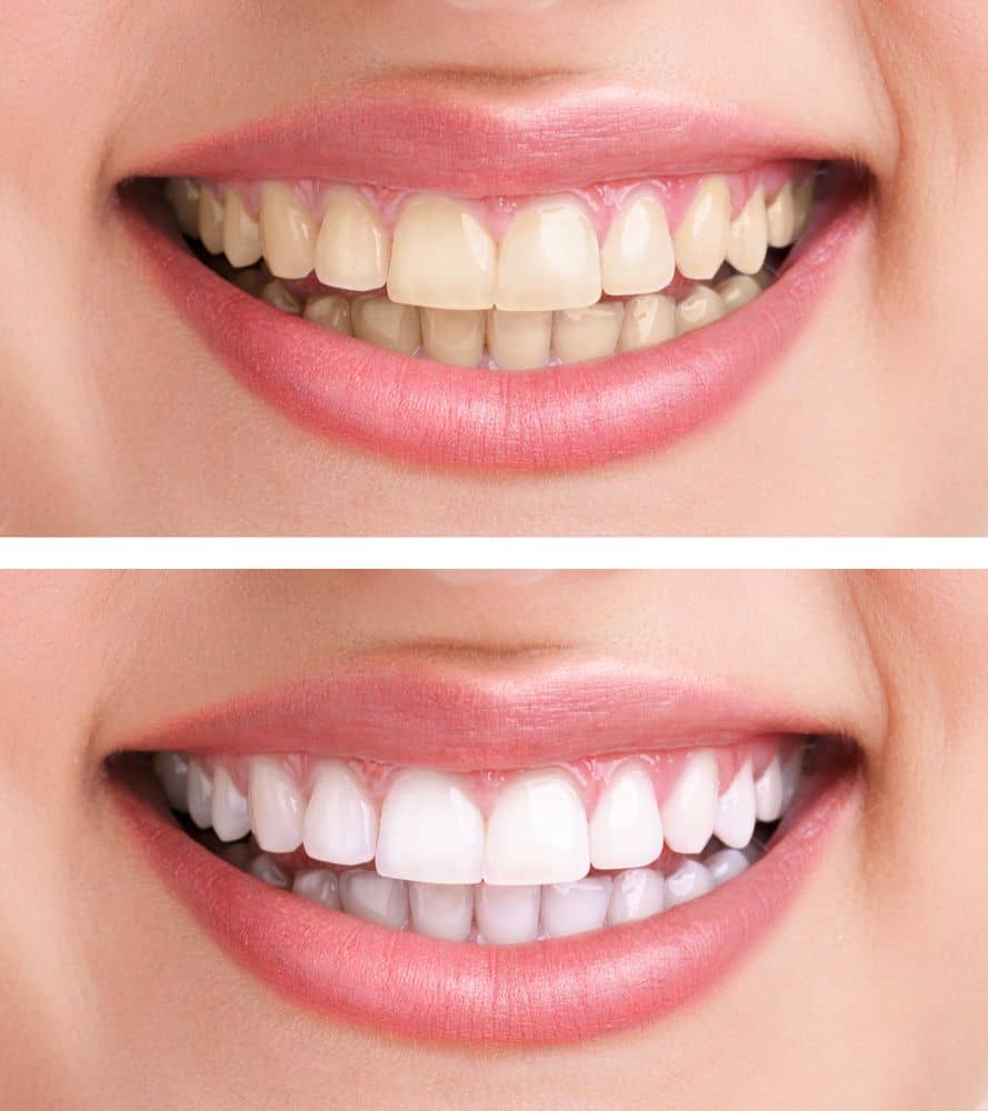 how to remove brown stains between teeth