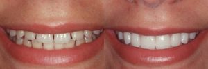 do porcelain veneers stain