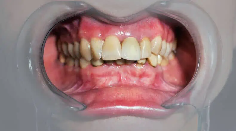 39306Diastema Treatment Cost: Close Gaps between Teeth with Braces, Veneers or Bonding