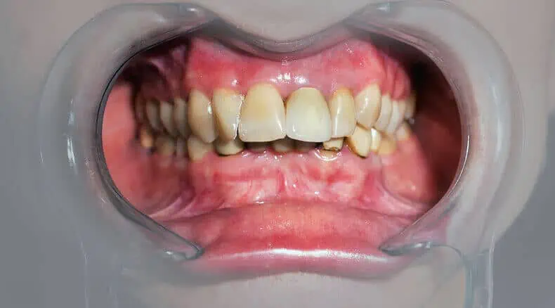 white spots on teeth