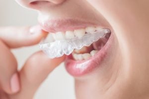 who can wear impress aligners?