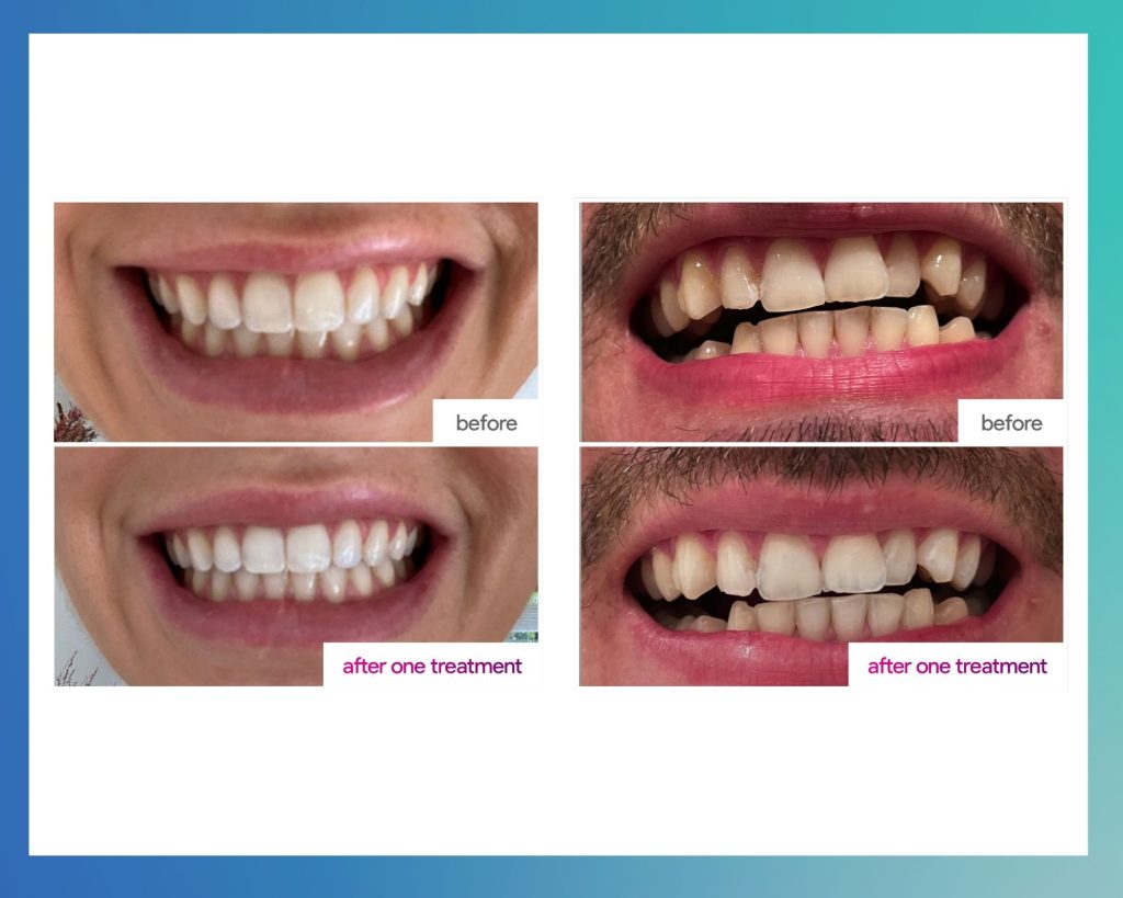 teeth whitening before and after dentist