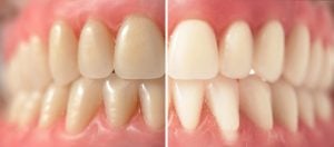 dental teeth whitening before and after