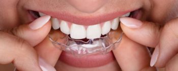 Impress aligners