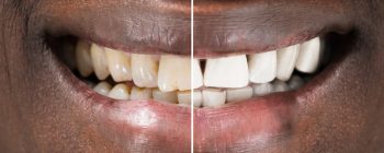 teeth whitening before and after