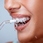 37480Essix Retainer Guide: What do Clear Plastic Retainers Cost in the UK?