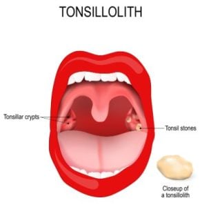 tonsiliths
