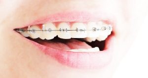 nhs invisalign