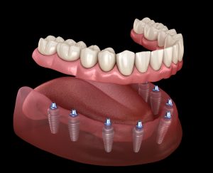 all on 8 dental implants Turkey