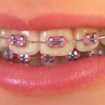 45768Can You Whiten Veneers? How To Whiten Porcelain and Composite Veneers