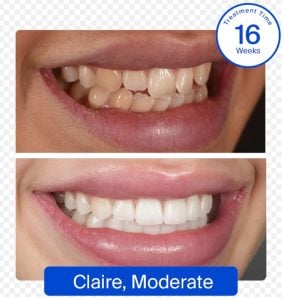 SmileWhite aligners before and after