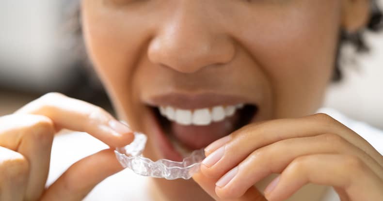 smile white aligners