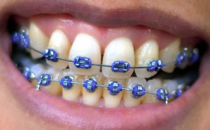 brackets de colores