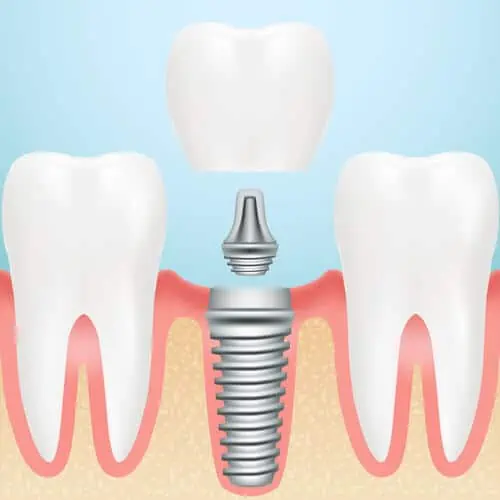 imagen de corona sobre implante dental