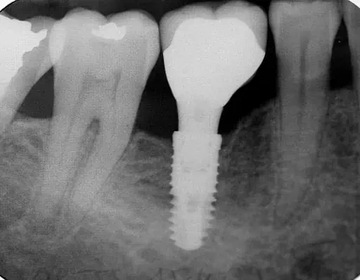 Radiografía de un implante endooseo