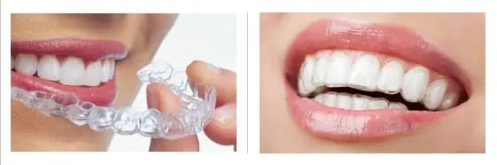 invisalign fotos antes y después