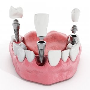 aesthetic teeth implants
