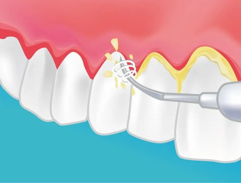 Tratamiento para periodontitis