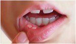 54465Liquen plano oral: tratamiento natural, causas, síntomas, potencial cancerígeno y más
