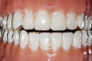 precio de ortodoncia invisiling