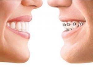 invisalign ortodoncia invisible