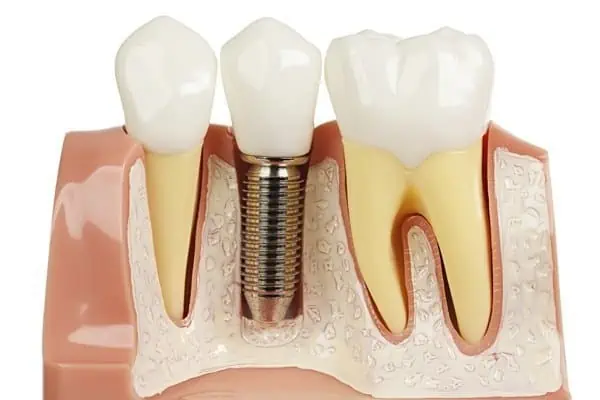 tooth implant diagram