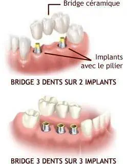 puente sobre implantes